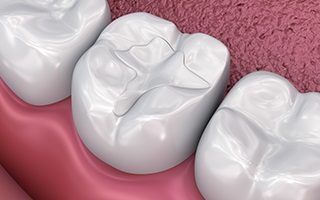 Tooth Colored Fillings